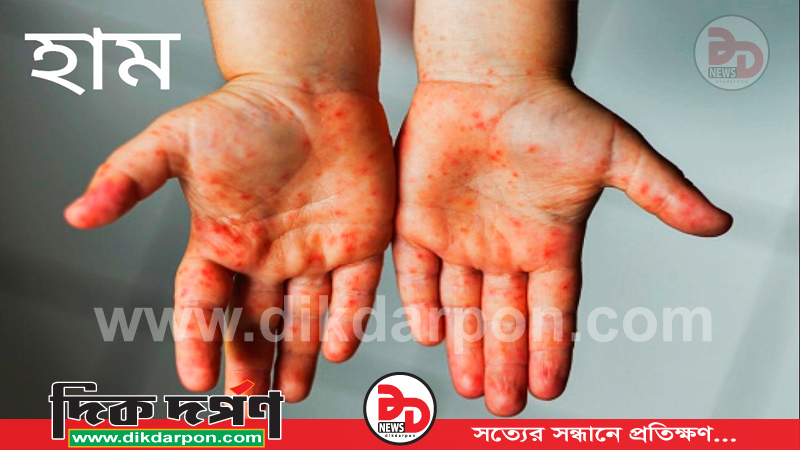 চাঁপাইনবাবগঞ্জে হামের টিকাদান প্রায় লক্ষ্যমাত্রা পূরণ, রোগী ১০১৭জন